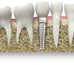 Implantes Dentales